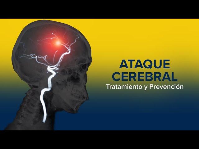 Tratamiento y prevención de un ataque cerebral (ictus)