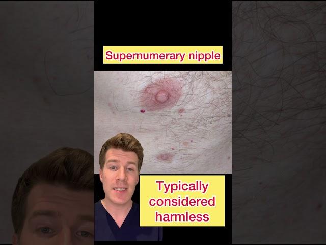 Part 2: SUPERNUMERARY NIPPLE AKA THIRD NIPPLE EXPLAINED #shorts #medical #doctor #health