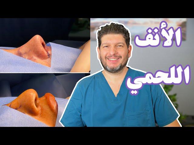 تجميل الأنف اللحمي