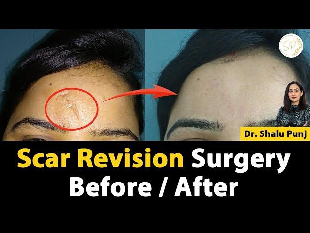 Scar Revision Surgery Before and After "Spark Clinique"  #scarrevision #plasticsurgeon