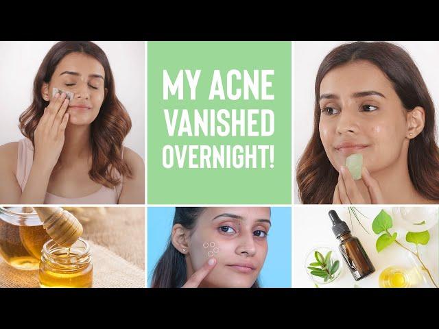 How To Make Your Acne Disappear Overnight | 4 Home Remedies For Pimples