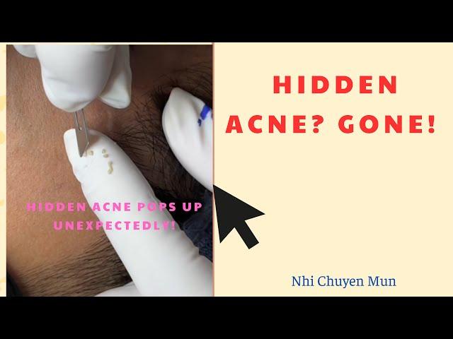 𝐄𝐱𝐭𝐫𝐚𝐜𝐭 𝐇𝐢𝐝𝐝𝐞𝐧 𝐀𝐜𝐧𝐞 𝐒𝐚𝐟𝐞𝐥𝐲 – 𝐍𝐨 𝐃𝐚𝐫𝐤 𝐌𝐚𝐫𝐤𝐬, 𝐍𝐨 𝐒𝐜𝐚𝐫𝐬 (𝐏𝐚𝐫𝐭 𝟏)