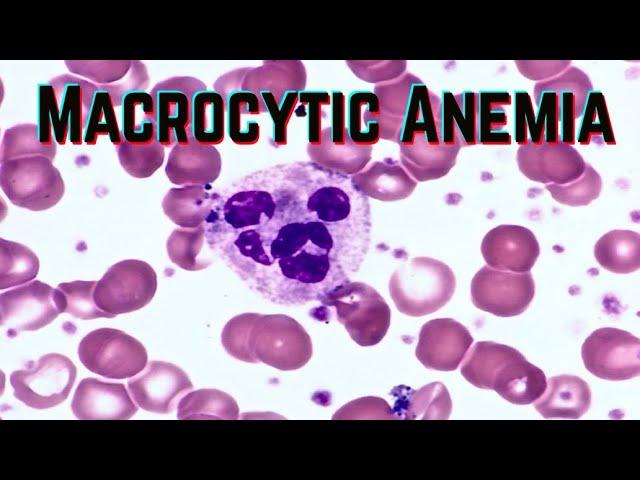 Macrocytic Anemia (updated 2021) - CRASH! Medical Review Series