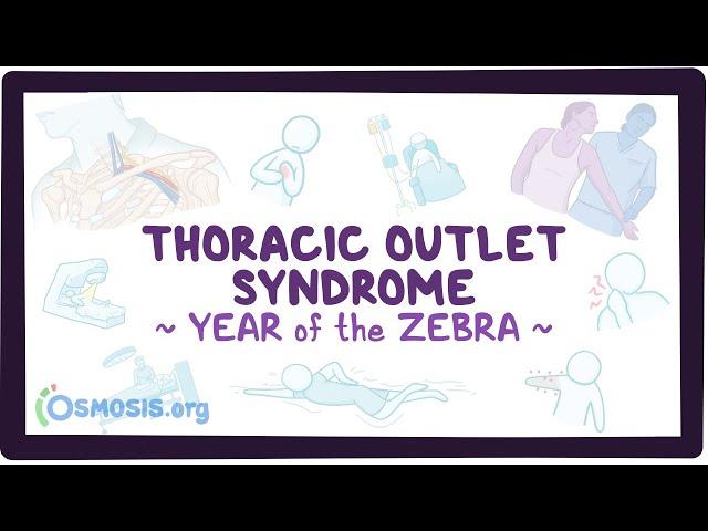 Thoracic outlet syndrome (Year of the Zebra)