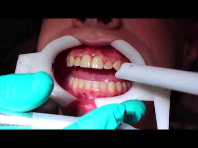 Gingival Recontouring (Reshaping the gum tissue with a laser)