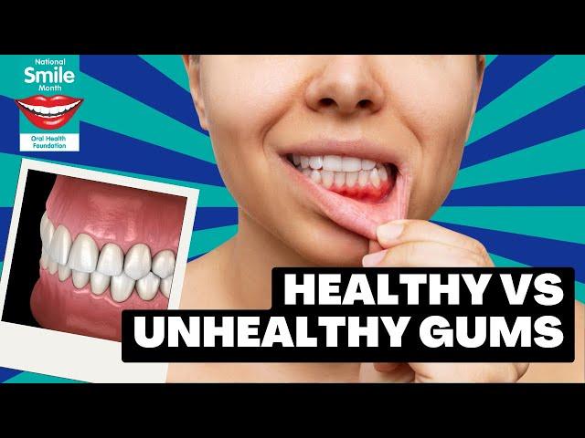 Spotting Gum Disease Early