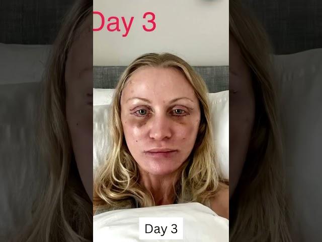 3 Month Facelift Healing and Recovery Process!