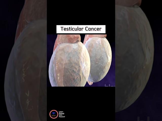 Testicular Cancer