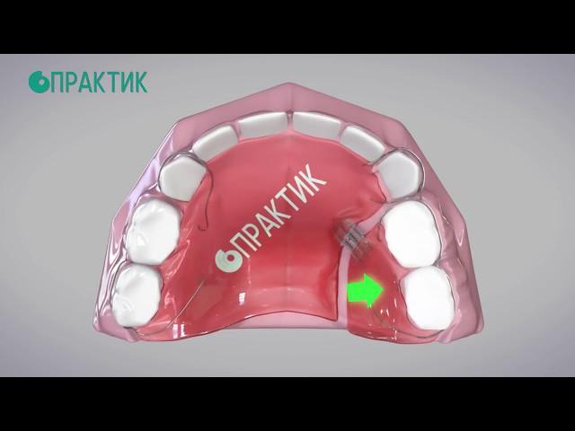 Ортодонтические пластинки на зубы для детей.