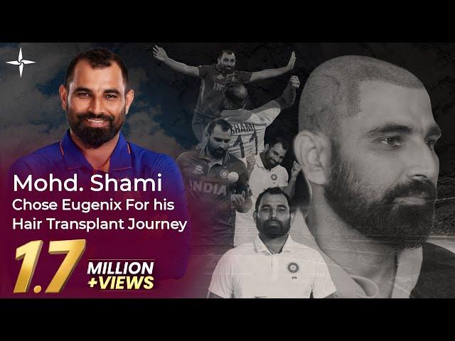 Cricketer Hair Transplants: Mohd. Shami's Hair Transformation Journey with Eugenix