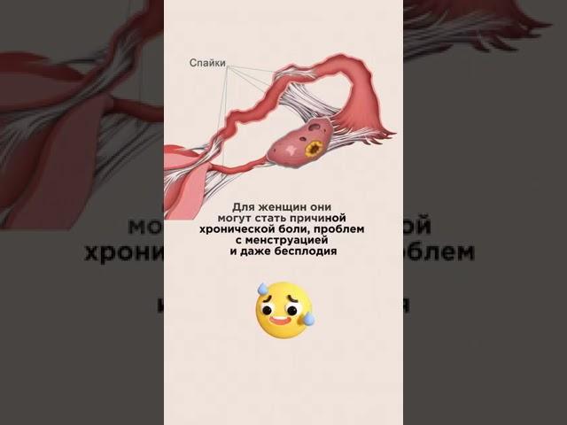 ‍️ Спайки. Способы лечения