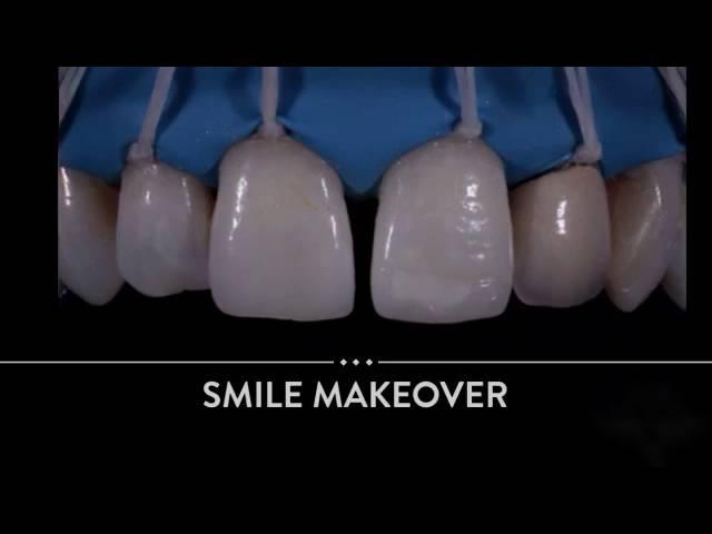 Smile makeover