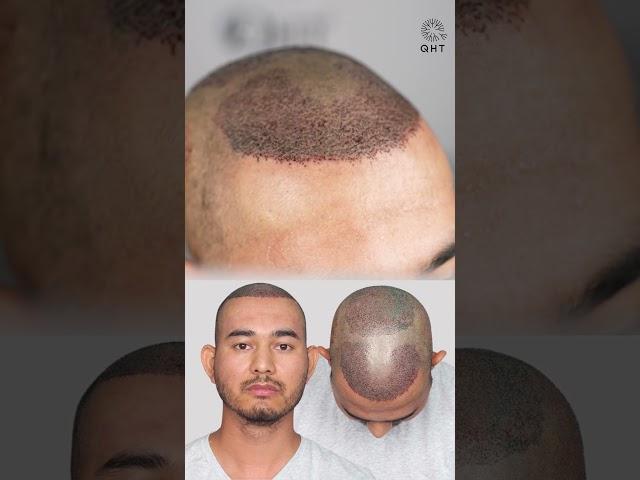 Twenty Five Months Hair Transplant Results | Latest Fue Technique #shorts #viral #hair transplant