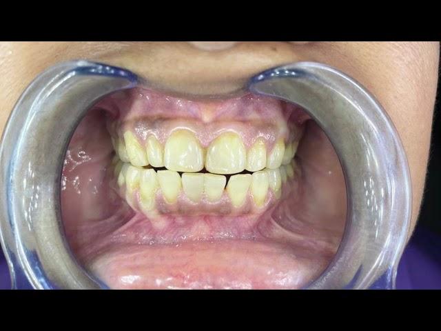 Before and After | In Office | Laser Teeth Whitening | By Dr. Jugal Panchal (Cosmetic Dentist)