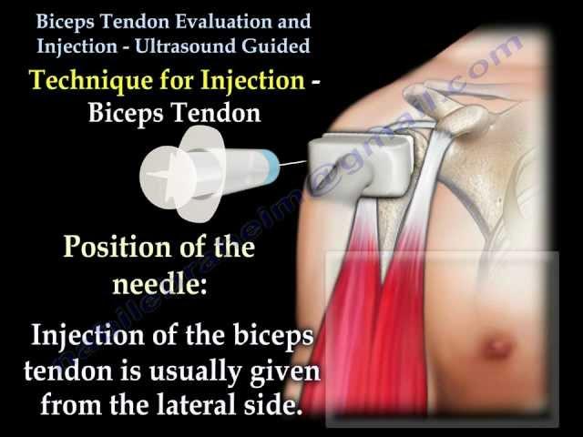 Biceps Tendon Evaluation, Injection Ultrasound  - Everything You Need To Know - Dr. Nabil Ebraheim