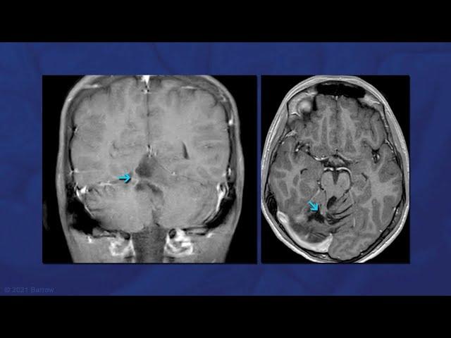 Lateral Supracerebellar Infratentorial Approach for a Recurrent Vermian Cerebellar AVM