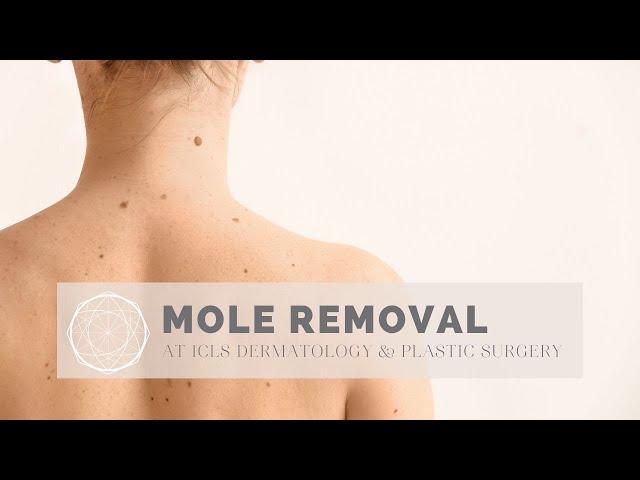 Mole Removal using Shave Excision Technique