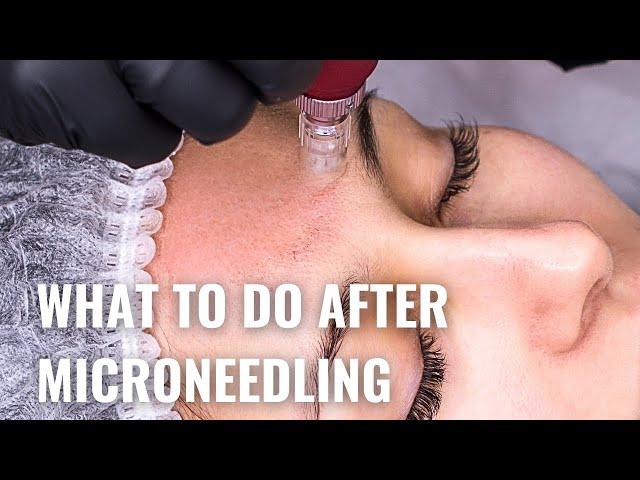 Microneedling Aftercare - Do's and Don'ts for Best Results