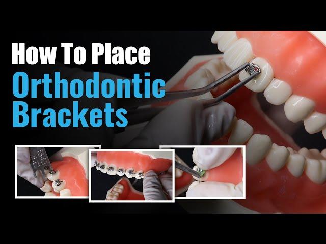 How to place Orthodontic Brackets | Waldent Metal Bracket Kit MBT 022 Slot