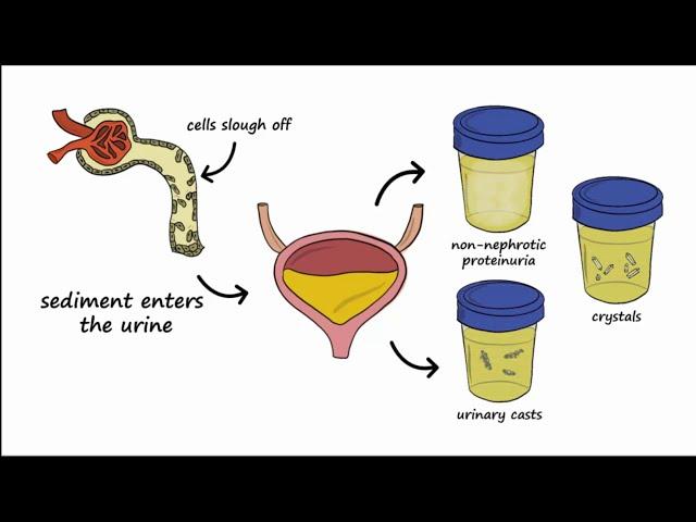 Analgesic Nephropathy (AN), Kidney Damage from NSAIDs