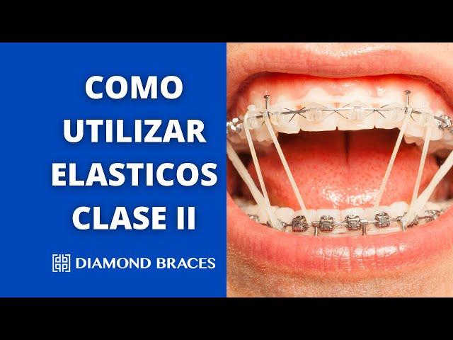 Como Utilizar Class II Elásticos