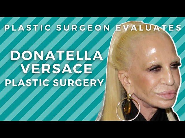 Donatella Versace Before and After Plastic Surgery: Silicone Disaster?!