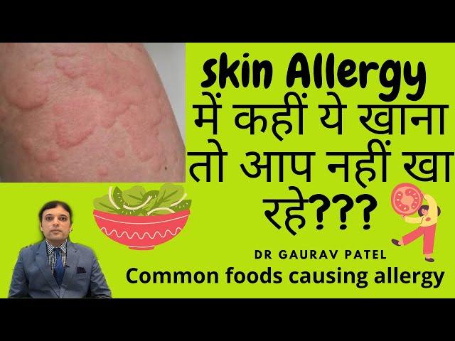 Skin allergy में ये खाना तो बिलकुल नहीं खाना हे। Foods to be avoided in urticaria | Dr Gaurav Patel