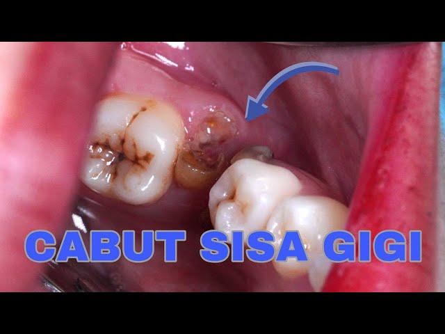 PROSES CABUT SISA GIGI | Dentist | Dokter Gigi Tri Putra