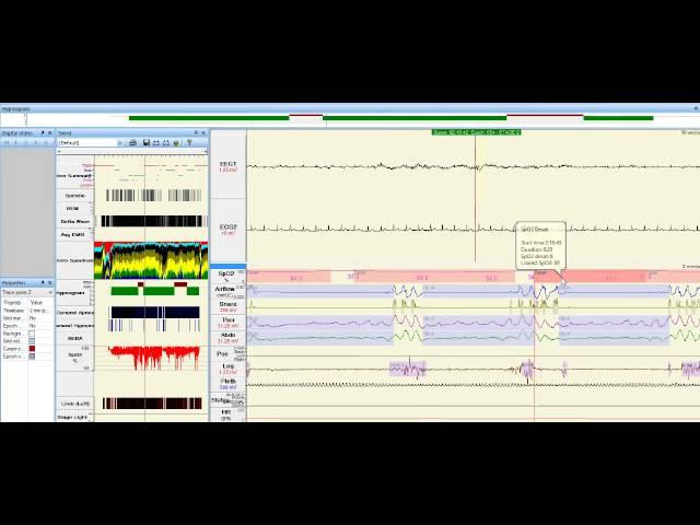 Sleep Study Data- A closer look at sleep apnea