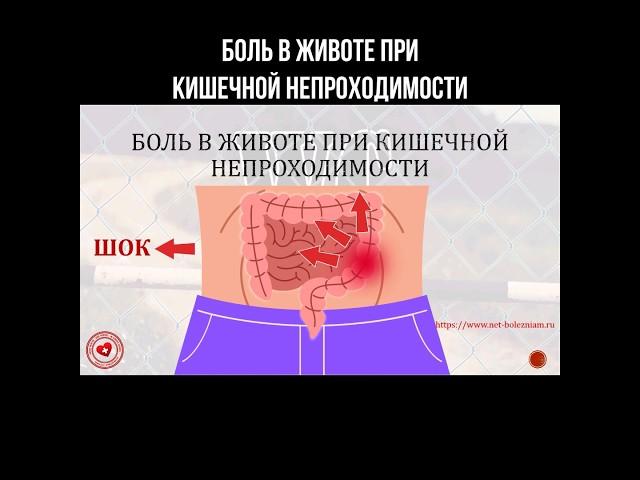 Боль в животе при кишечной непроходимости #кишечник #болитживот #больвживоте #живот