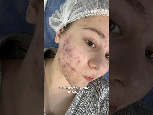 ЭТО СЛУЧИЛОСЬ СО МНОЙ #кожа #акне #макияж #здоровье #beauty