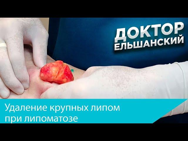 Удаление крупных липом при липоматозе Removal of lipomas in multiple lipomas (lipomatosis)