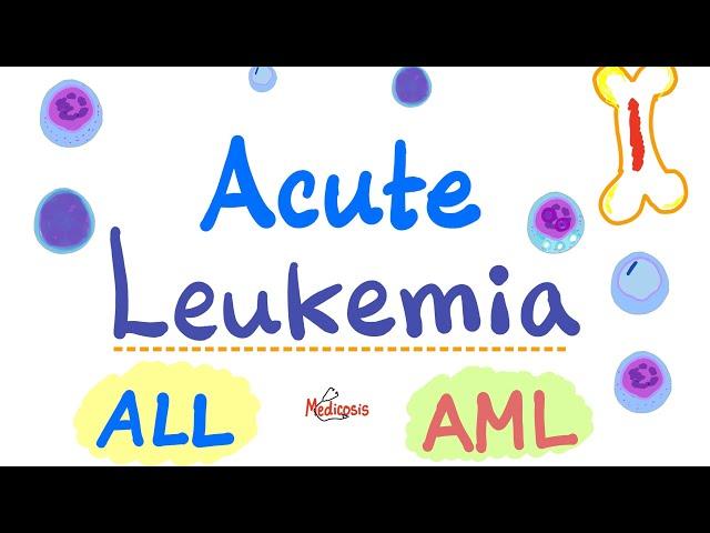 Acute Leukemia - ALL and AML - Hematology and Oncology Series