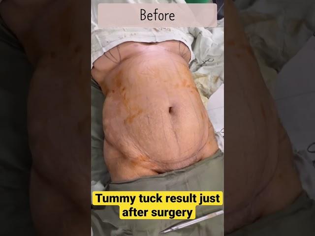 ঝুলে যাওয়া পেট টানটান করার উপায় | Tummy tuck surgery in Bangladesh | Abdomen liposuction