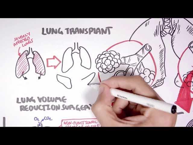 Emphysema Treatment