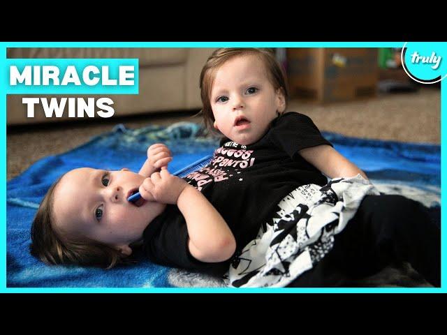 Our Conjoined Twins Were Given 24 Hours To Live | MY EXTRAORDINARY FAMILY