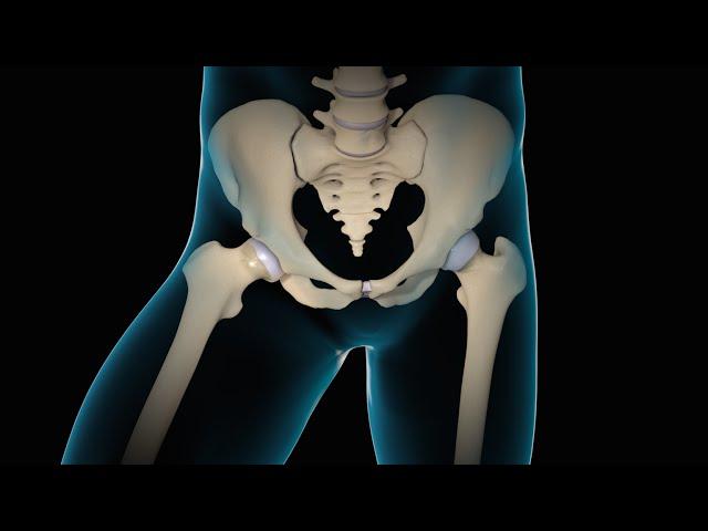 Minimally Invasive Total Hip Replacement | THR | Nucleus Health