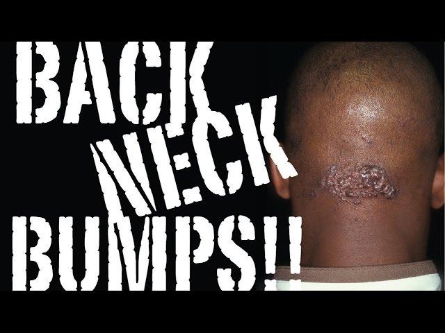 HOW to STOP BACK NECK BUMPS and KELOIDS: the Cause & the CURE / Part 1