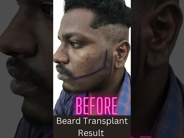 Beard Transplant Result #beardtransplant #hairtransplant #dermatologist #bestskincare #beard