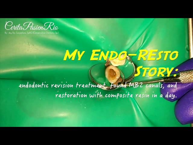 My endo resto revision treatment story on maxillary molar with 4 canals (spesialis konservasi gigi)