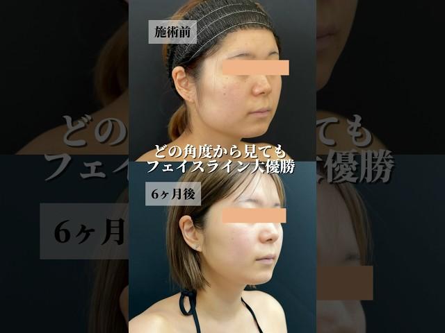 フェイスライン綺麗にするなら本多の脂肪吸引