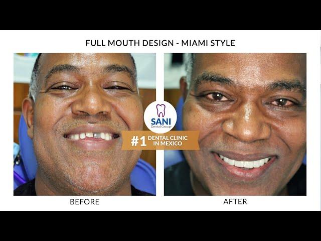 Follow our Patient's Journey-Full Mouth Makeover Cancun