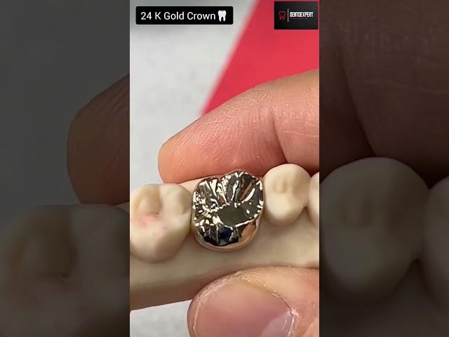 24 Karat Gold Crown | Golden tooth capping #shorts #dentist #viral ‍