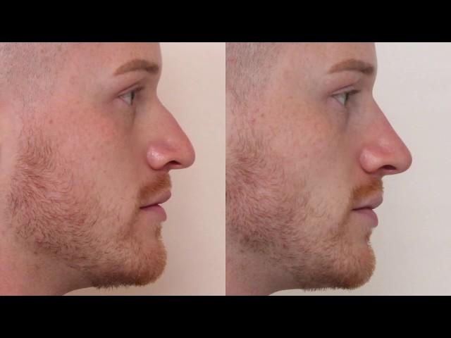 Male Non-Surgical Rhinoplasty