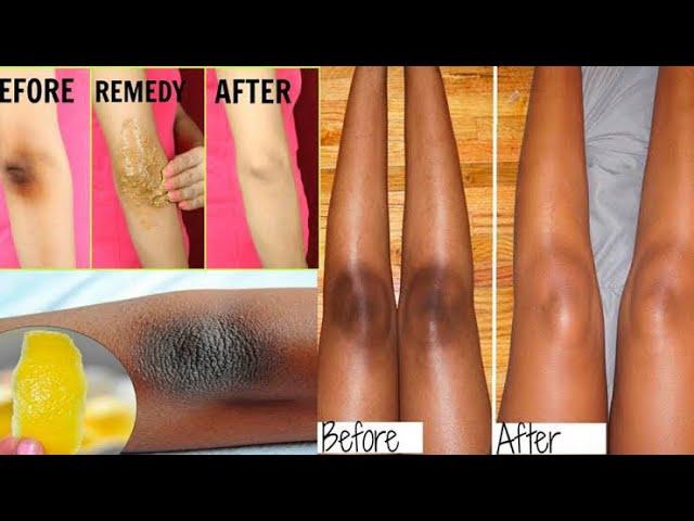 HOW TO LIGHTEN DARK UNDERARM NATURALLY ANDFAST | PERMANENT RESULTS