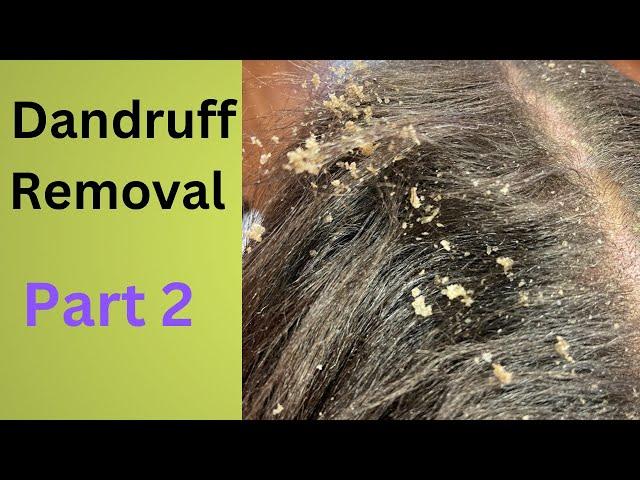 Dandruff Removal Part 2 | Huge Flakes