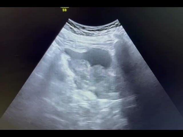 Ultrasound of ca bladder