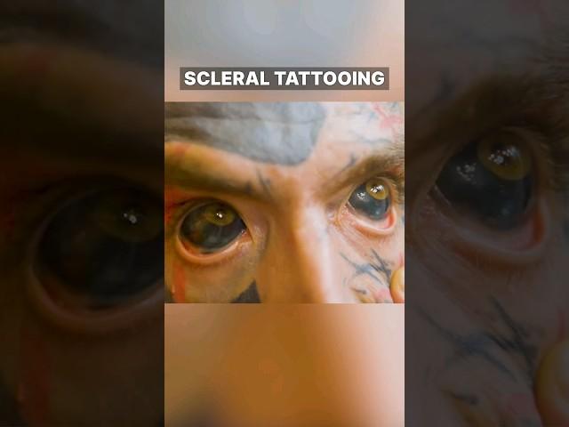 Eyeball Tattoo!? (Scleral Tattoo)