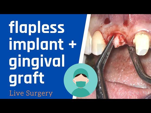 Flapless DENTAL IMPLANT SURGERY with connective tissue graft - LIVE