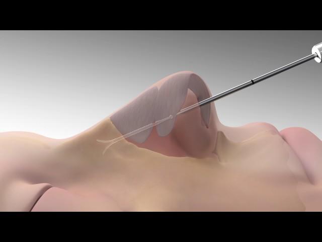 LATERA Animation for Patients with Nasal Congestion